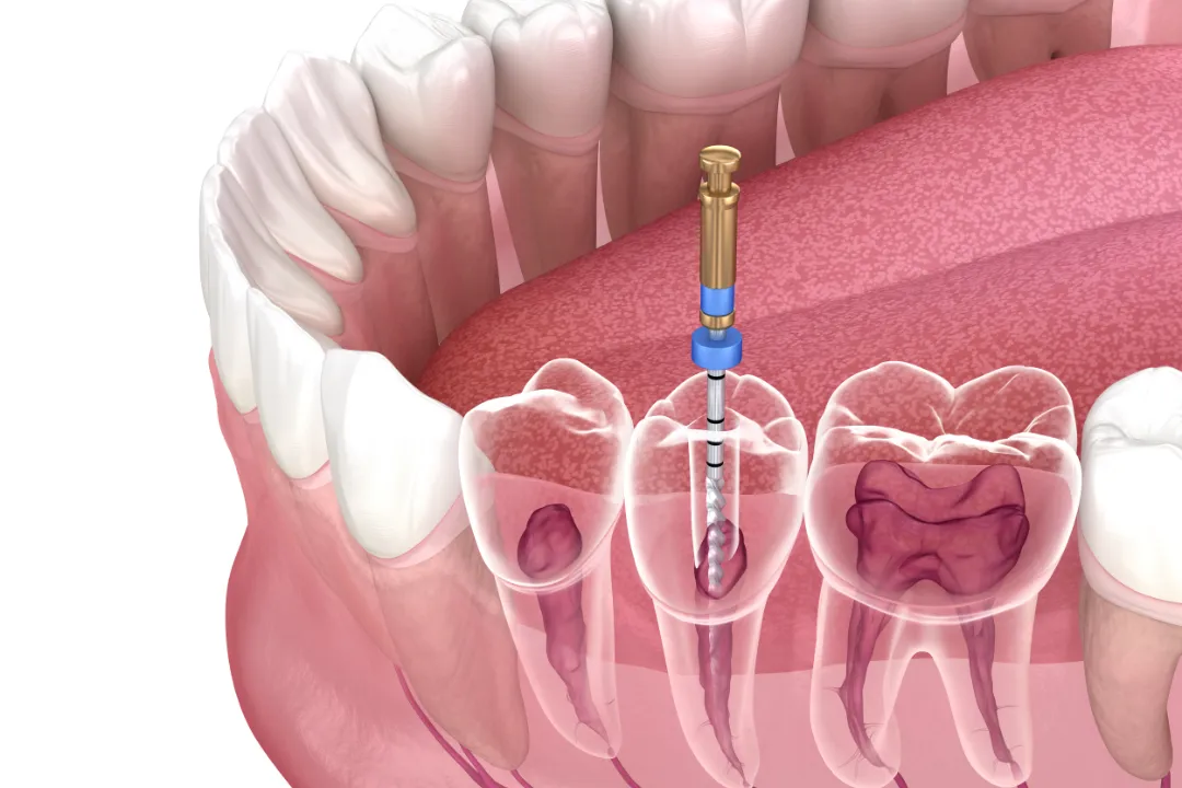 Root Canal Treatment Penrith