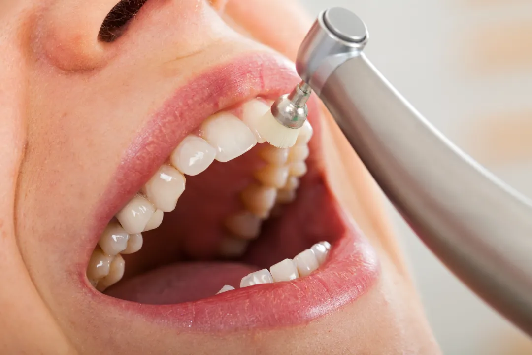 Teeth Cleaning Penrith