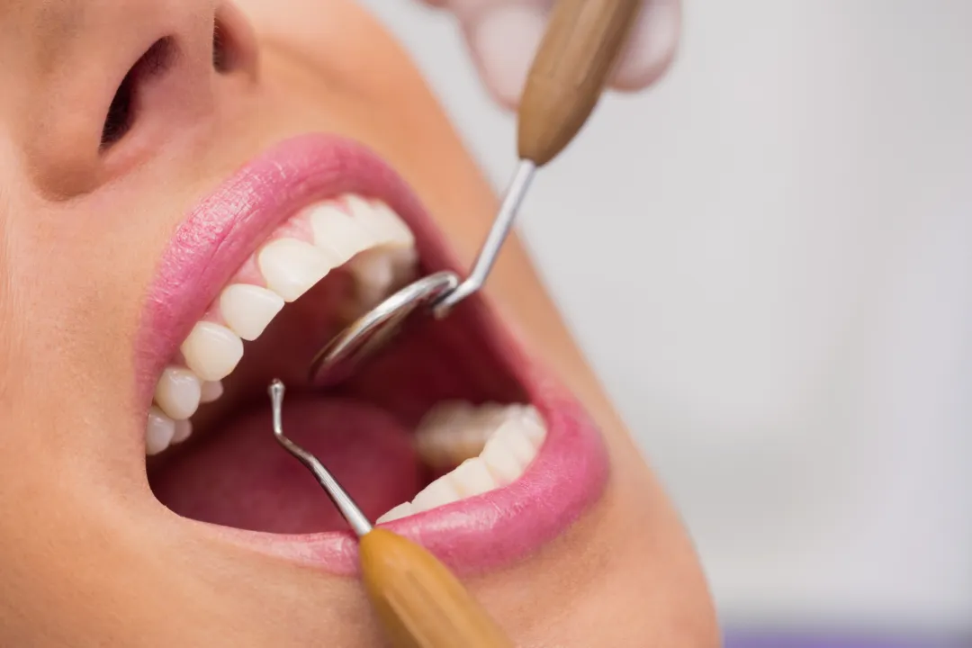 Tooth Extraction Penrith