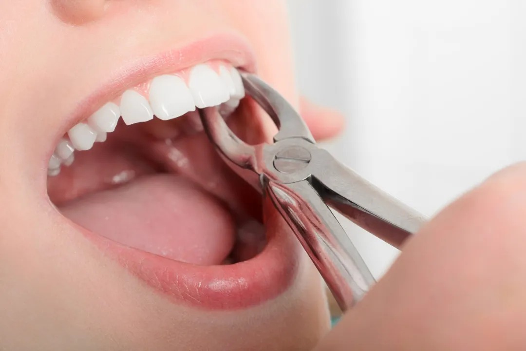 Wisdom Teeth Removal Penrith
