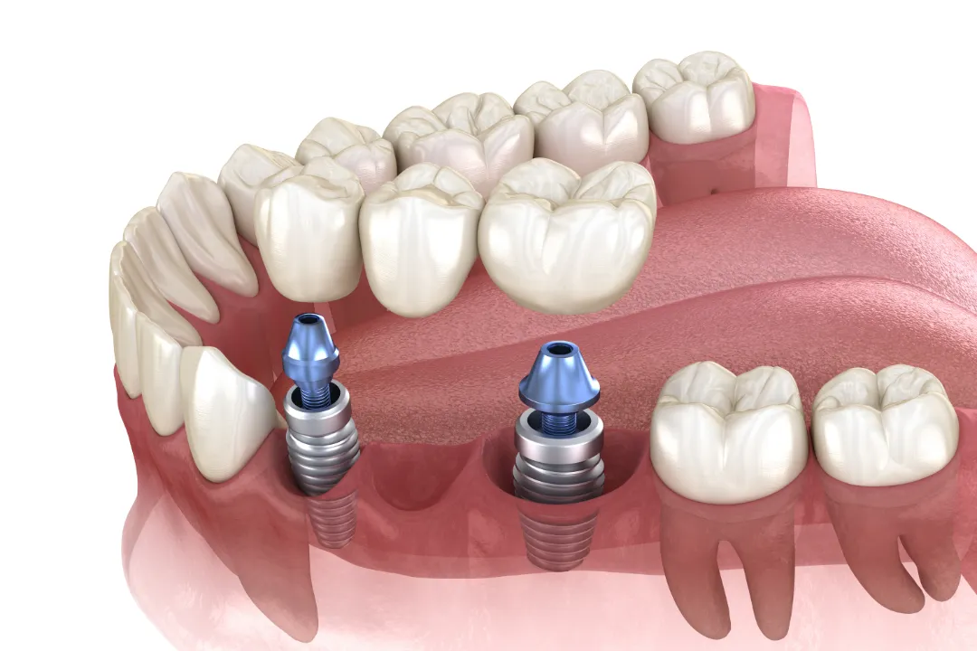 Dental Crowns Penrith