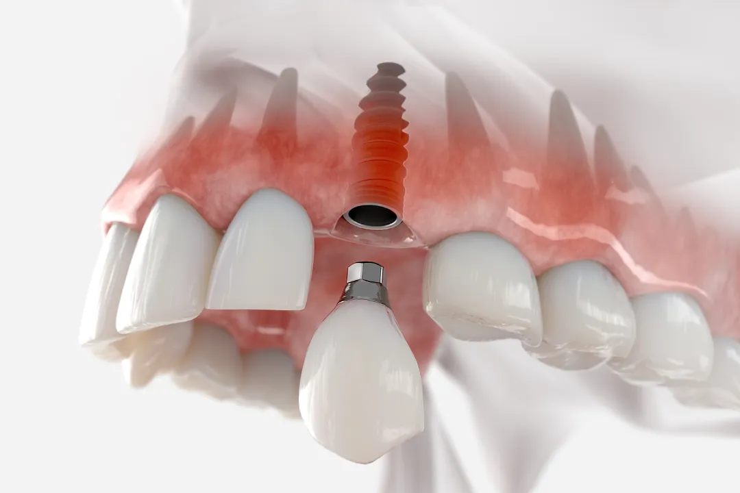 Dental Implants Penrith