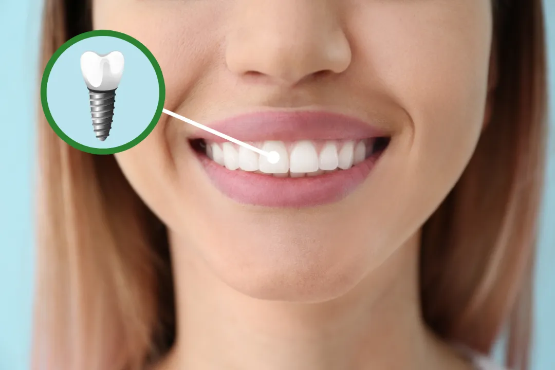 Dental Implants Penrith